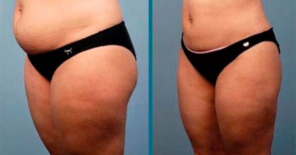 methods to lose weight by 10 kilograms in a month
